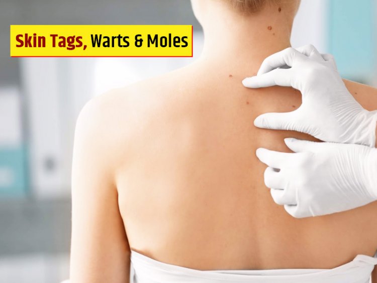How to identify skin tags and moles