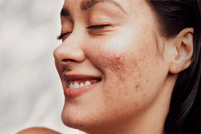 10  Moisturizers for Acne-Prone Skin That Won’t Break You Out